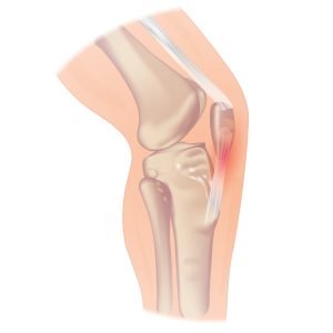 imagen de rodilla para ilustrar la tendinitis rotuliana