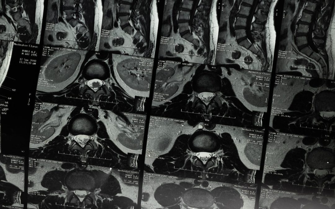 Rehabilitación de Sacroileitis