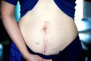 persona con cicatriz en abdomen que necesita tratamiento post quirúrgico de abdominoplastia