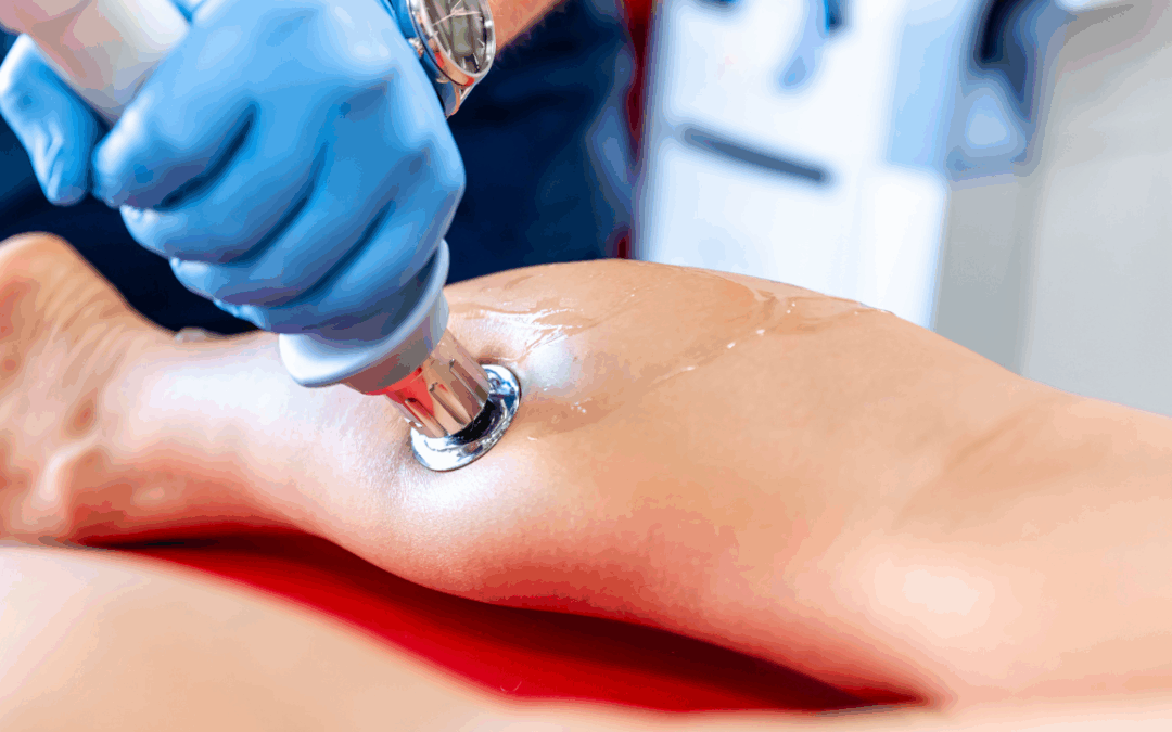 Tratamiento de fascitis plantar con ondas de choque